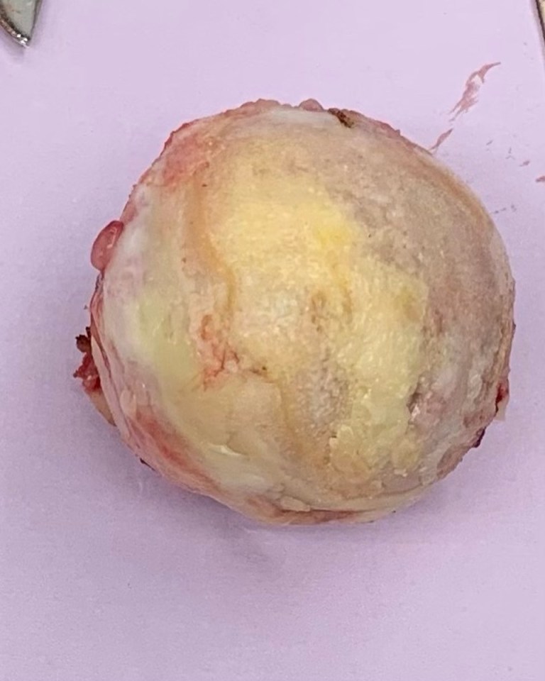 The pop diva also posted an image of what appears to be a ‘femoral head’  — the highest part of the thigh bone, which is replaced during the hip op