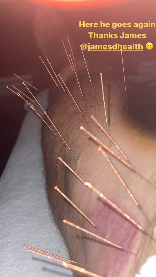 David shared a photo of his shin and calf covered in cooper needles