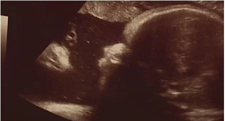 Do you see the christ-like figure in Alicia and Zac’s ultrasound?