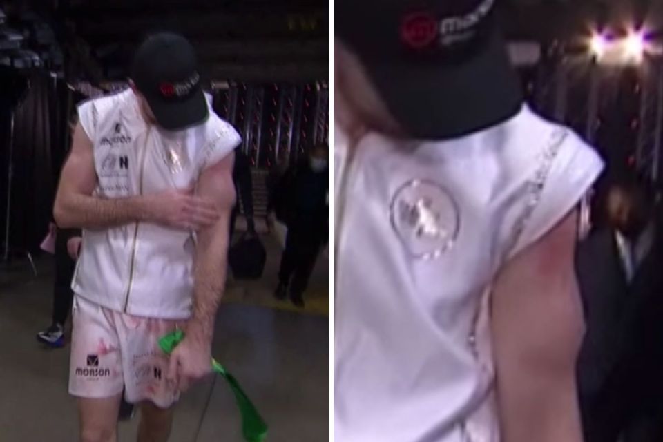 Callum Smith showed off his bulging arm after suffering a horrific injury