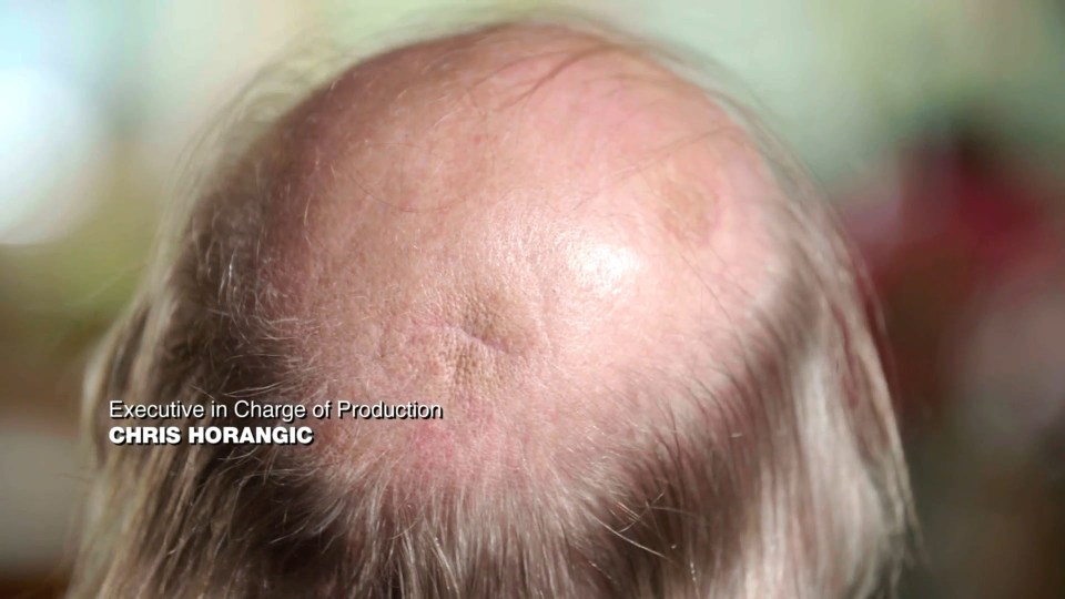 After surgery, Dennis' scalp looked much better - and he could fit his helmet on