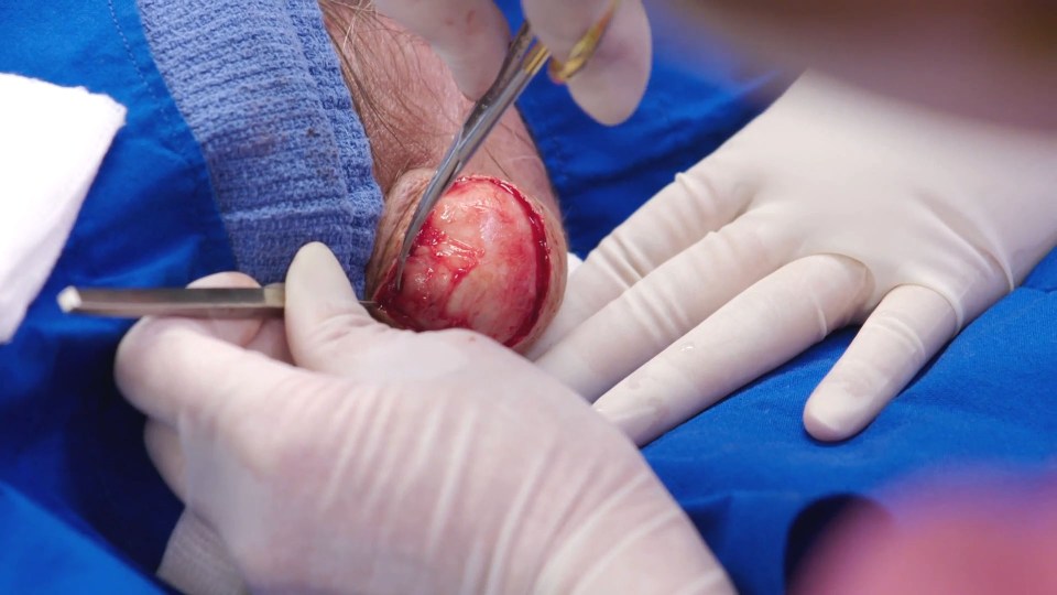 Dr Sandra Lee carefully cut around the cyst to get to the gory contents