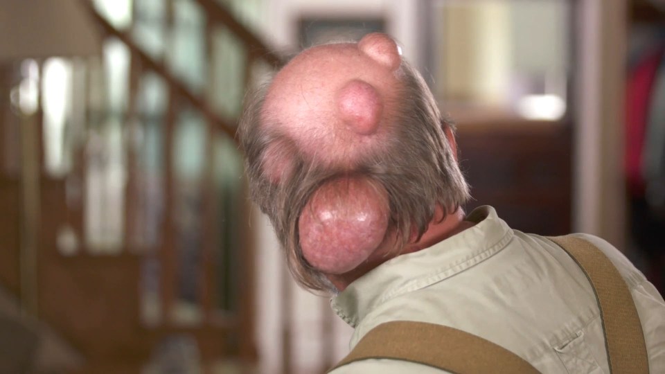 Dennis, 67, had been putting up with the growths on his head for twenty years