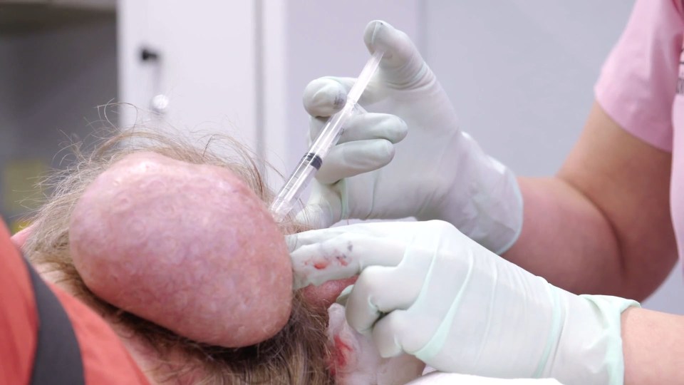 Dr Pimple Popper told him it was probably the largest nodule she's ever seen