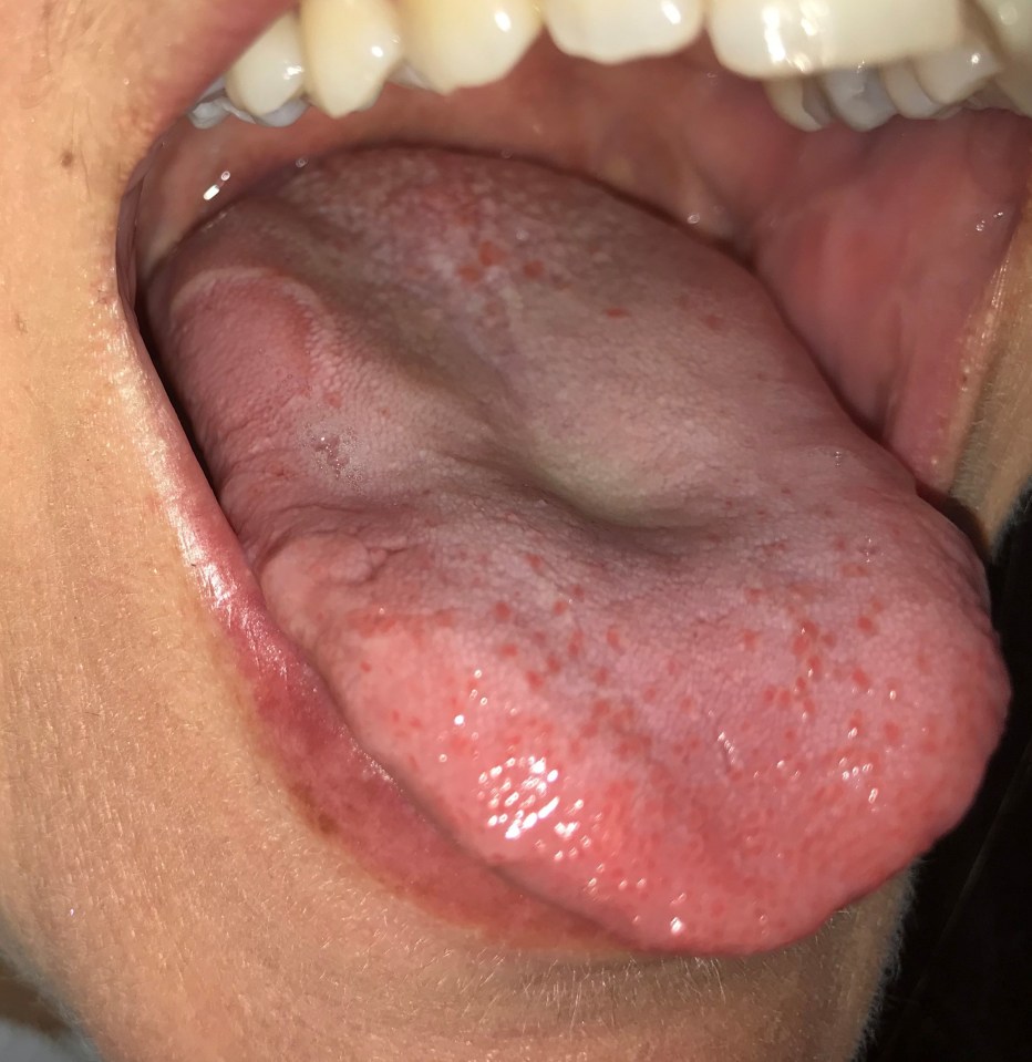 People with Covid-19 have suffered from little red bumps on their tongue, seen above 