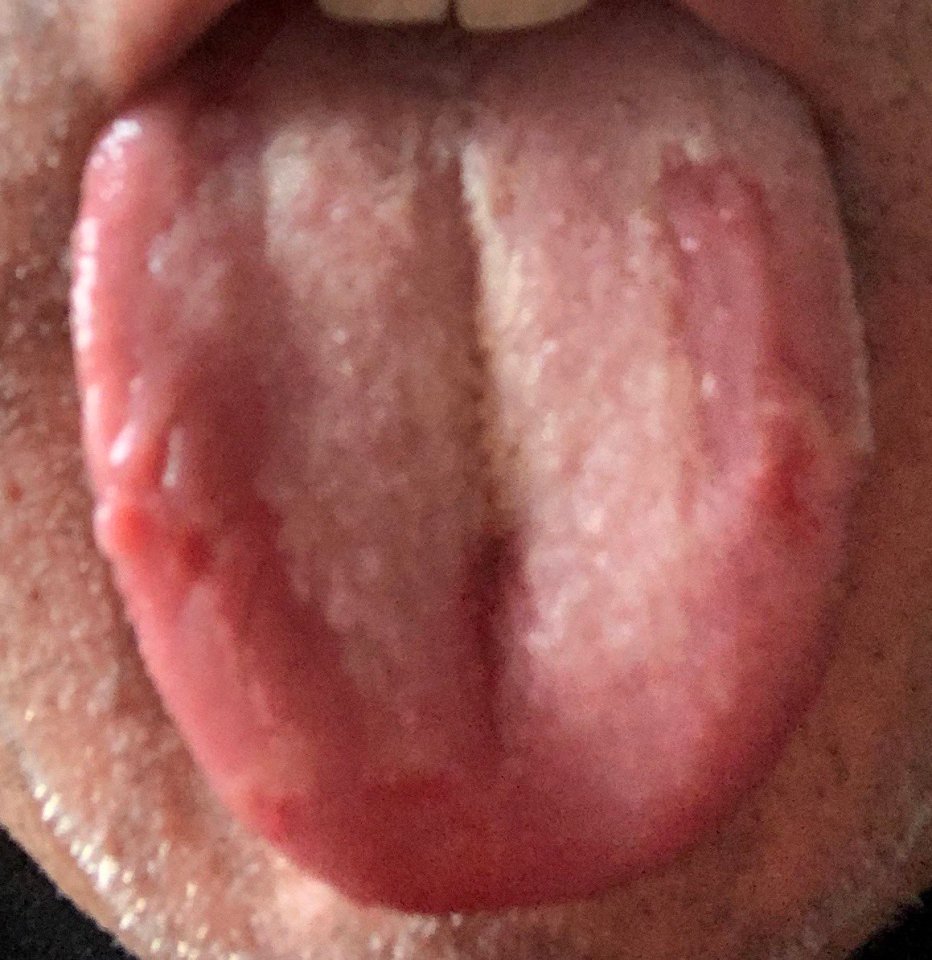 Professor Tim Spector, who runs the ZOE Covid Symptom Study app, warned he is seeing a rise in the number of people with 'Covid tongue'