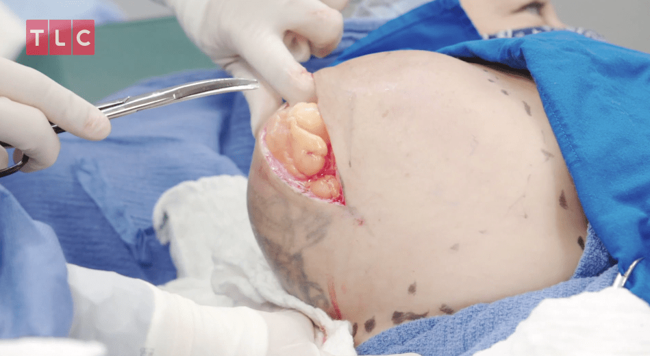 In the operating room, Dr Pimple Popper slices open the huge lump