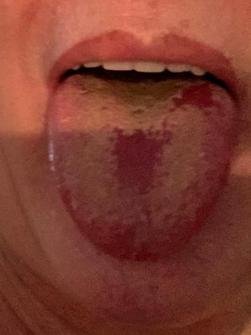 Others also experienced white marks on their tongue 