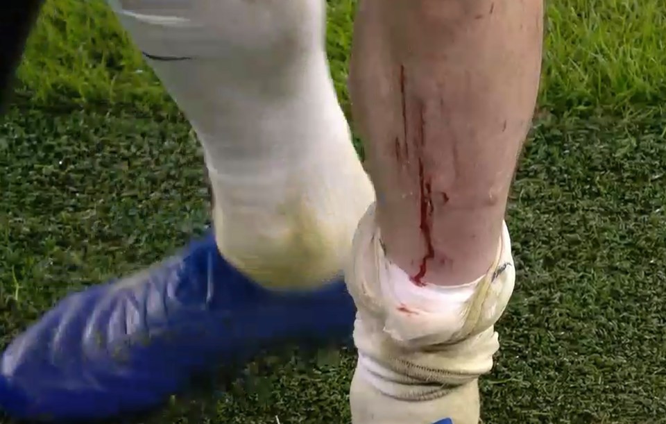 Blood poured down the Danish midfielder's shin as he hobbled off the pitch