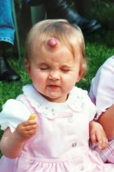 Molly-Mae Hague has shared an unseen childhood photo of a large strawberry birthmark on her forehead