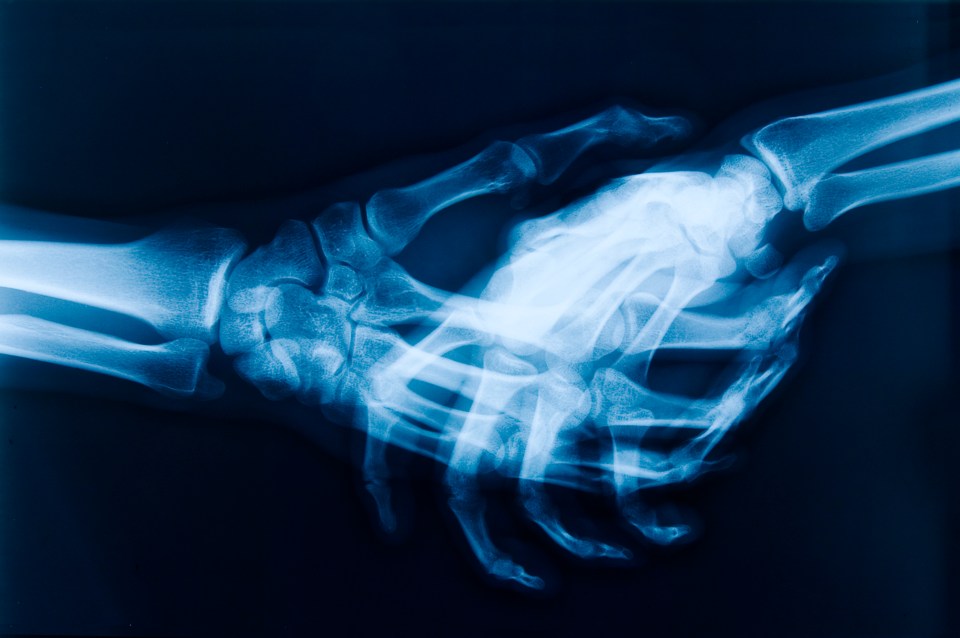 An X-ray of hands shaking - each hand has a total of 27 bones