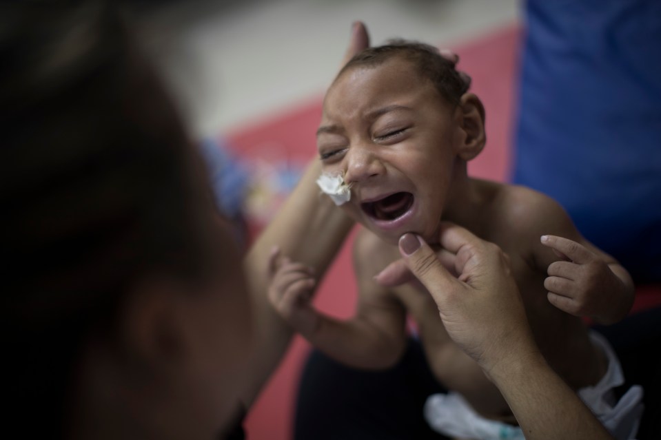 Zika can trigger birth defects such as shrunken heads in children