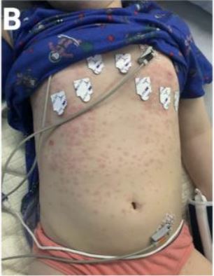 Researchers have shared pictures of a Covid-related skin condition to warn parents on what to look out for