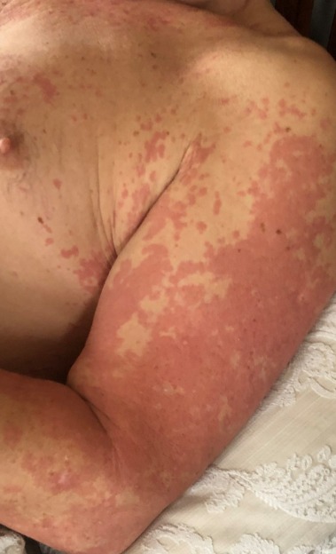 Viral exanthem is a widespread rash causes numerous reddish blotches or bumps over the body