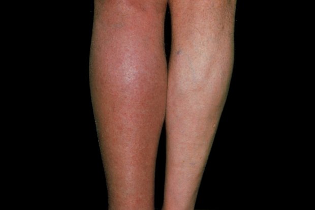 Deep vein thrombosis (DVT) can make a limb swollen and red (pictured)