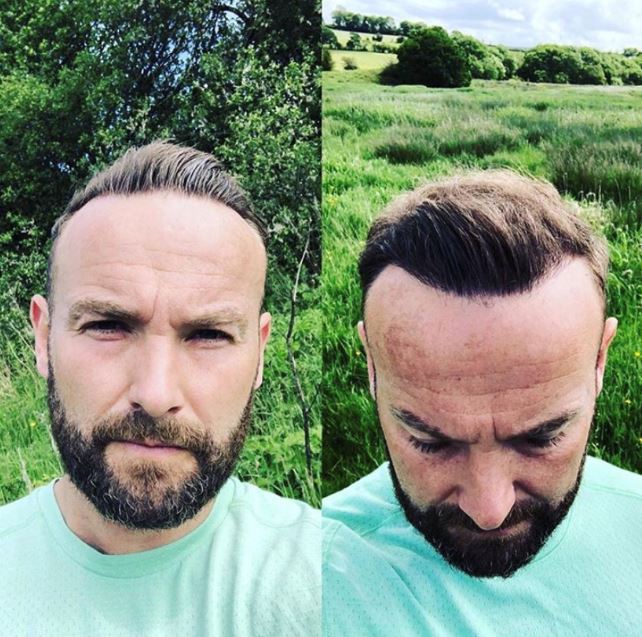 The results of his hair transplant were incredible