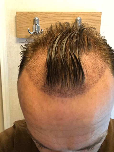 Kevin has opened up about his hair transplant, after having it two years ago