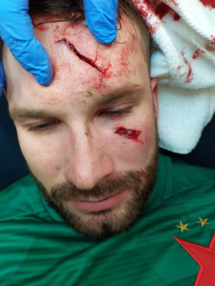 The Slavia Prague keeper sported a horrific gash