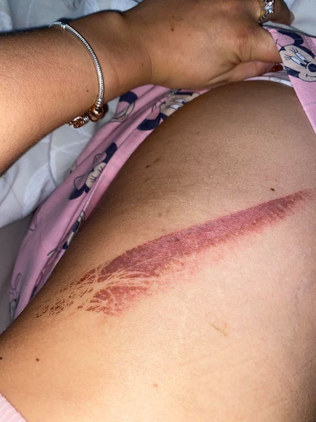 A woman fears she has been “scarred for life” after she was burnt by a radiator in a Best Western hotel