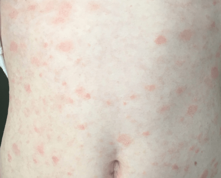 Pityriasis rosea caused by Covid