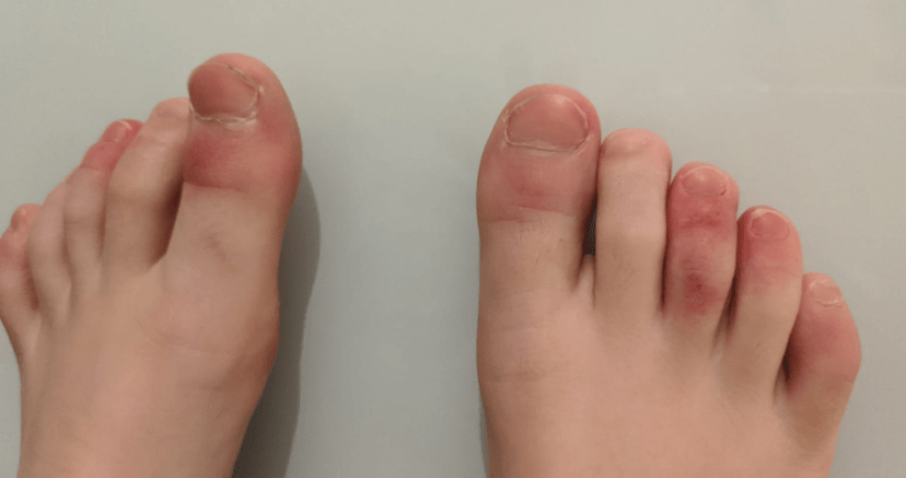 An example of Covid toes