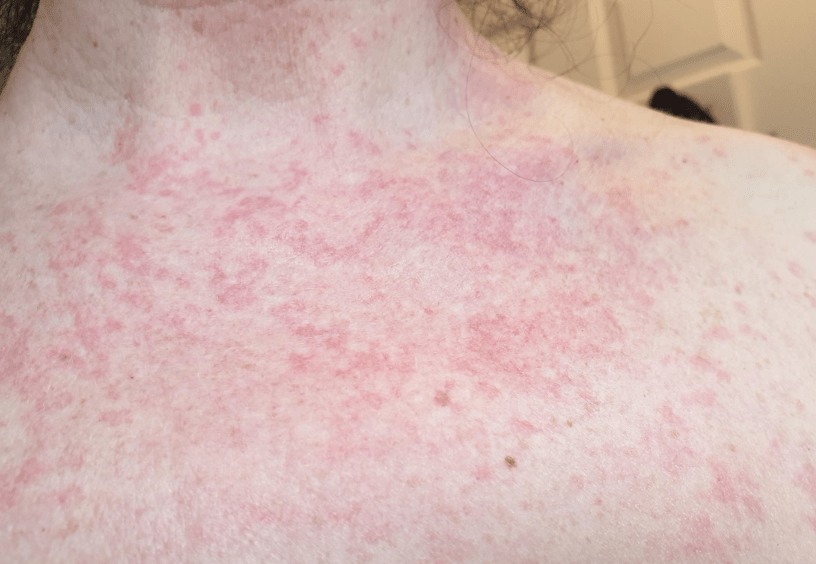 A woman with neck eczema due to Covid