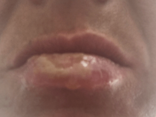 A blistered mouth caused by Covid disease