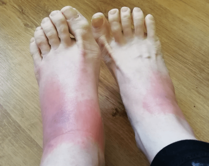 A bruise-like skin condition caused by Covid. The medical name is “purpuric rash”.