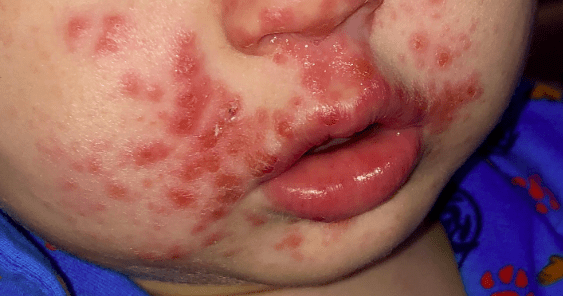 Papular and vesicular rash on a toddler with Covid