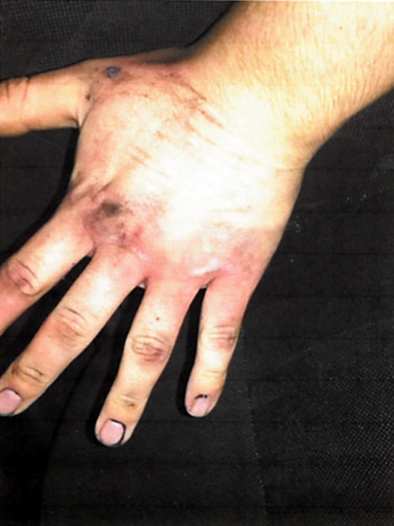 The horrific ordeal caused blistering burns to the mechanic's hands