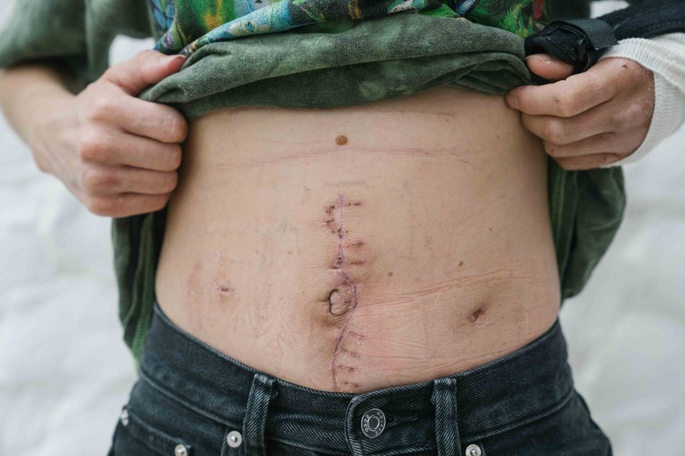 Melissa shows the scars on her stomach following surgery after the attack