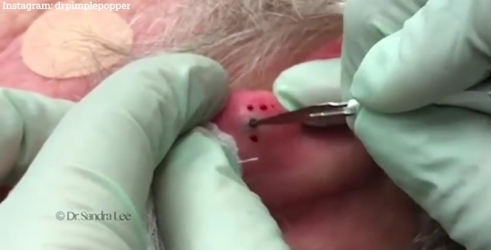 At first Dr Lee made an incision on either side of the blackhead