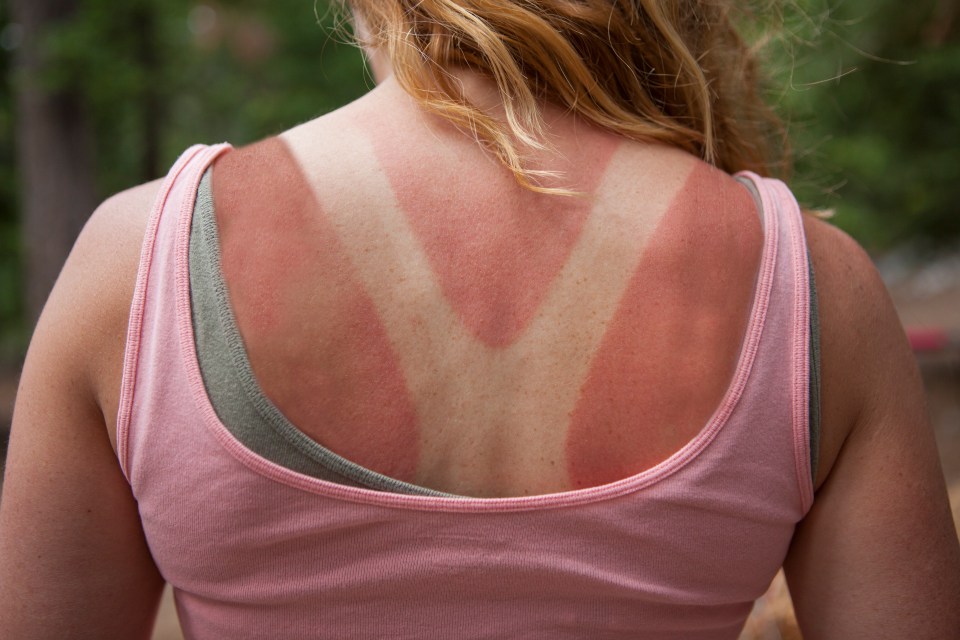  During sunny weather - it's key that you use protective lotions to stop your skin getting burnt