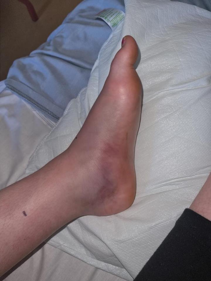 Grace Roys' foot and leg swelled up after she stood on an adder last week