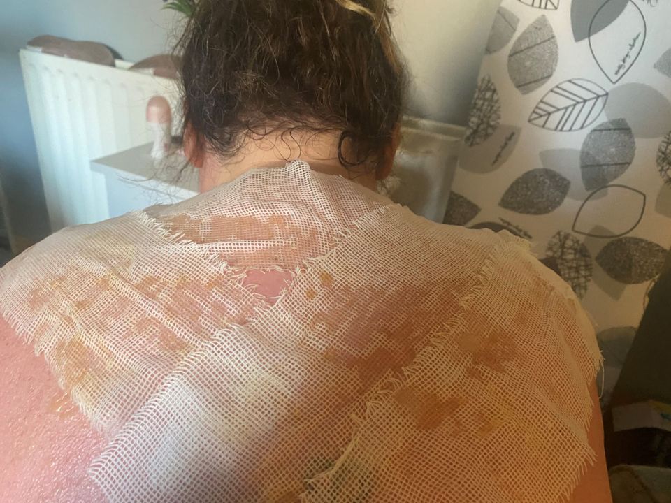 Danielle's back was covered in bandages at the hospital