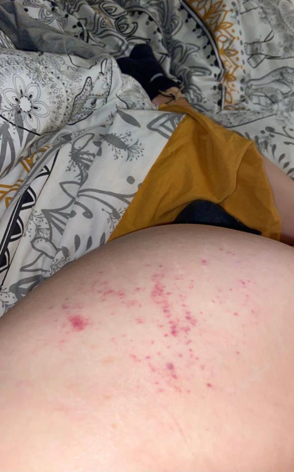 The unusual mark that appeared on Leah's left bum cheek, which was believed to have been caused by an 'angry' spirit