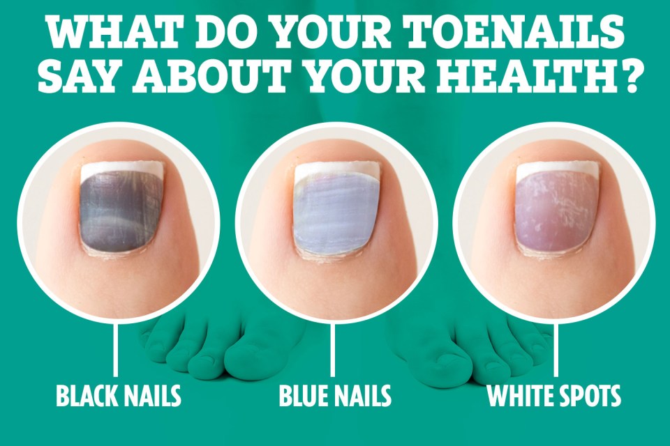 There are a number of underlying health conditions that could explain your discoloured toenails