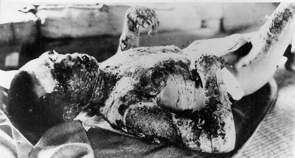 Victims were left blackened with radiation burns in the blast