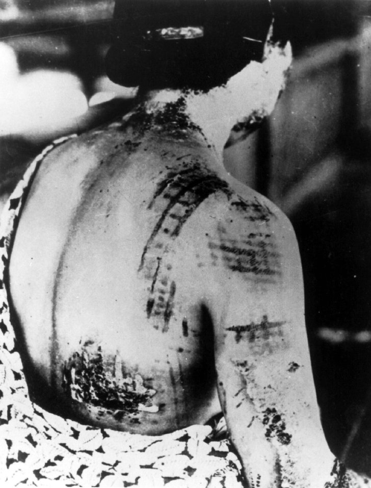 Clothing patterns were burned onto victims' flesh