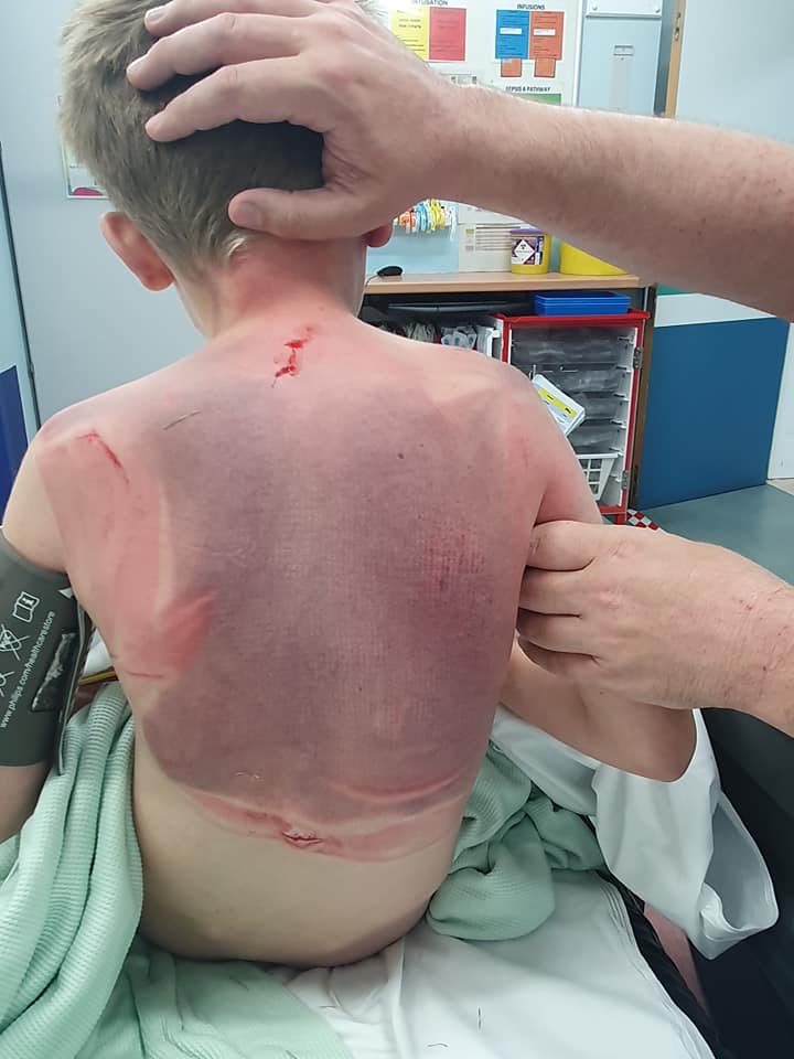 A mum has issued a warning to fellow parents after her son suffered ‘life-threatening’ injuries following a hot tub accident