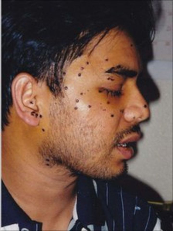 The right side of Rais Bhuiyan’s face was, and remains, peppered with pellets