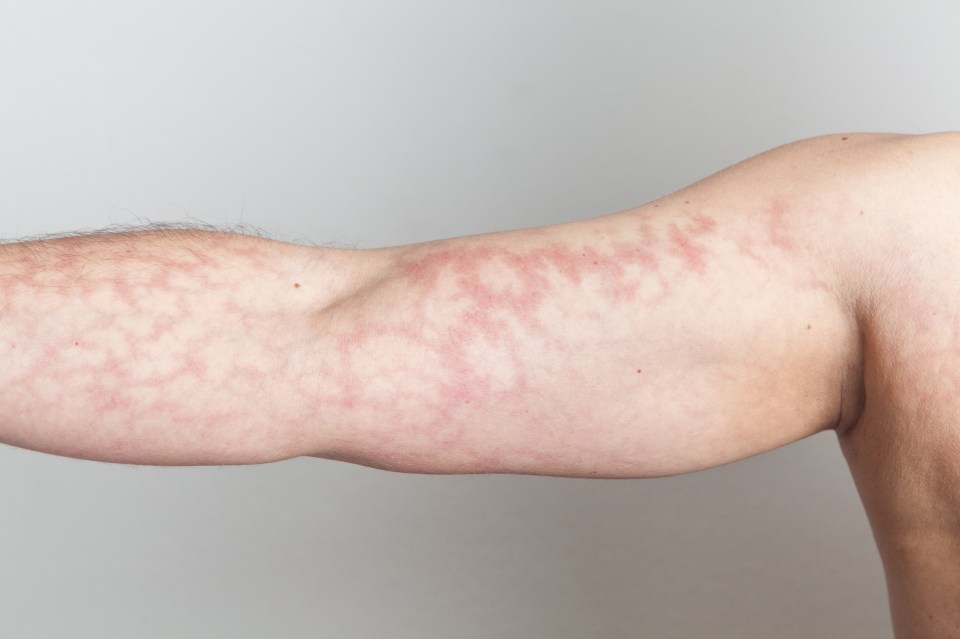 Adults can also have mottled skin although this is less common and may be down to medication