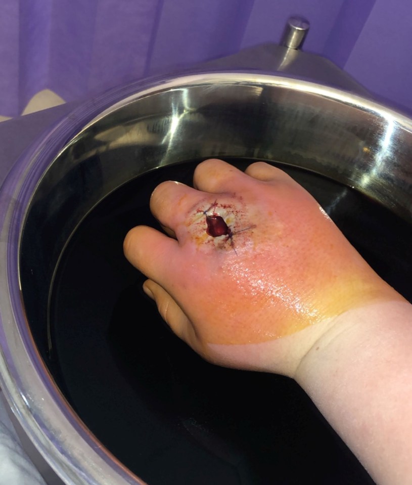 The carer bathed her hand in an iodine bath to clean out the wound