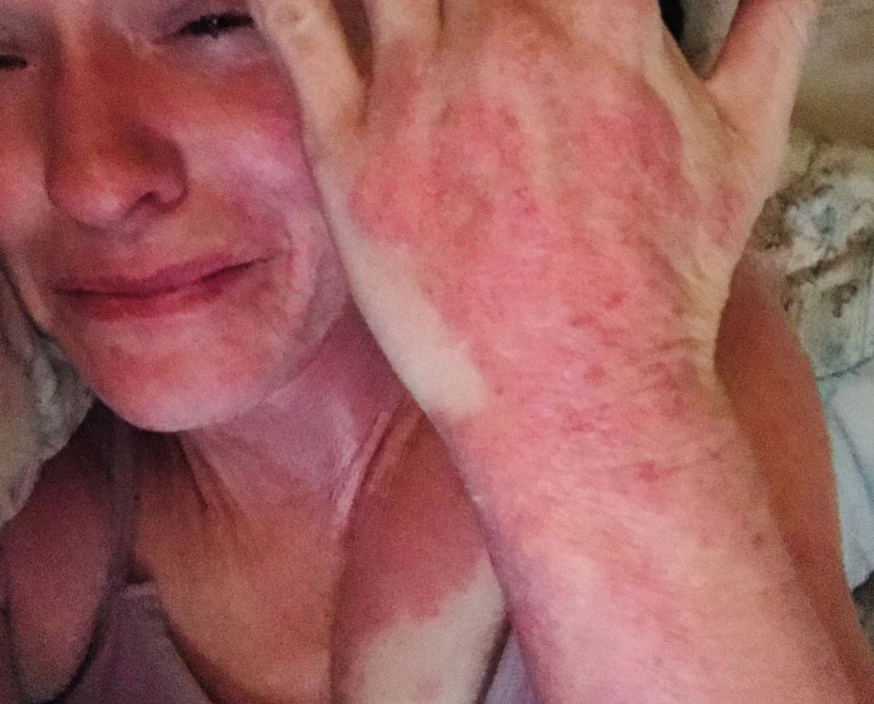 The 33-year-old started to get bad skin reactions which she thinks was linked to her coil