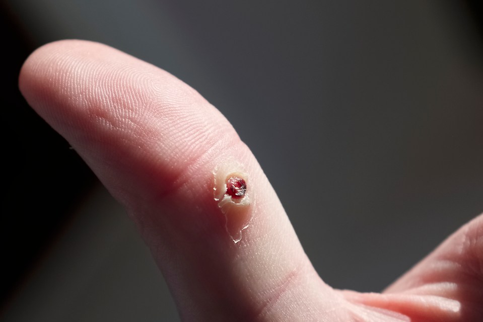 A thumb wart after freezing treatment