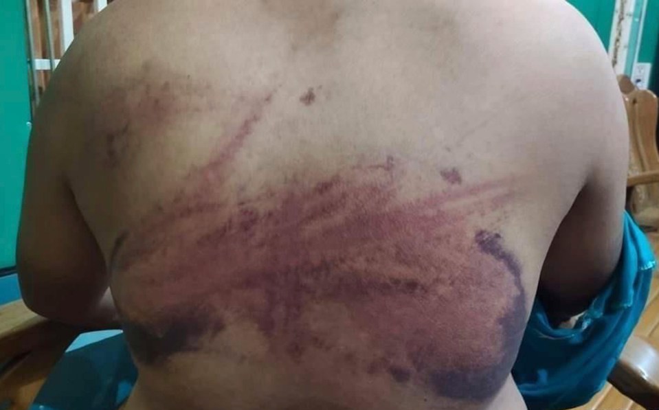 Photos show the shocking injuries of a prisoner who says he was tortured during interrogation