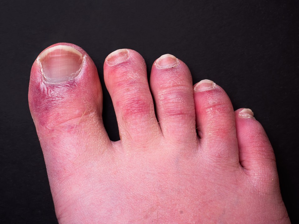 Example of someone suspected to have Covid toes caused by natural infection