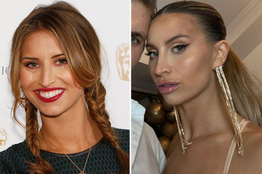 Ferne McCann – who had a nose job – has regularly shut down rumours about going under the knife