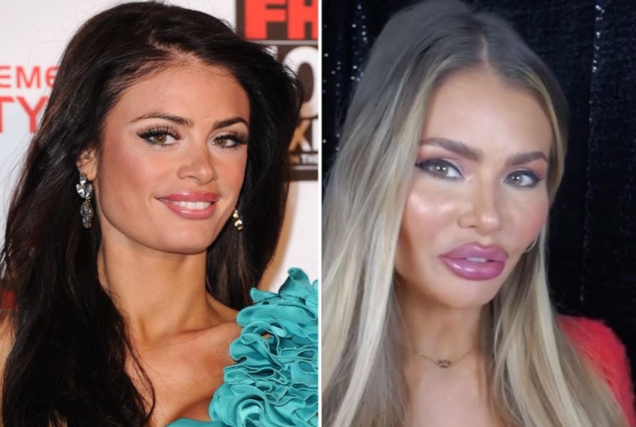 Chloe Sims 'sticks to Botox and fillers' after looking 'ridiculous' from having collagen injected into her lips