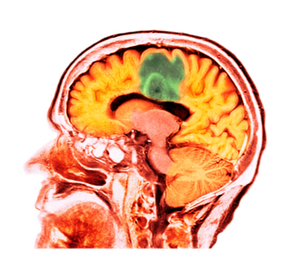 Ultrasound beams open the barrier and can help facilitate drug delivery, which could change the way the disease is treated